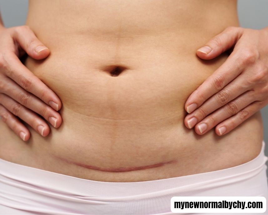 close-up-picture-of-the-belly-of-a-c-section-mom-The-Complete-Postpartum-Recovery-Guide-for-New-Moms-What-to-Expect-Week-by-Week