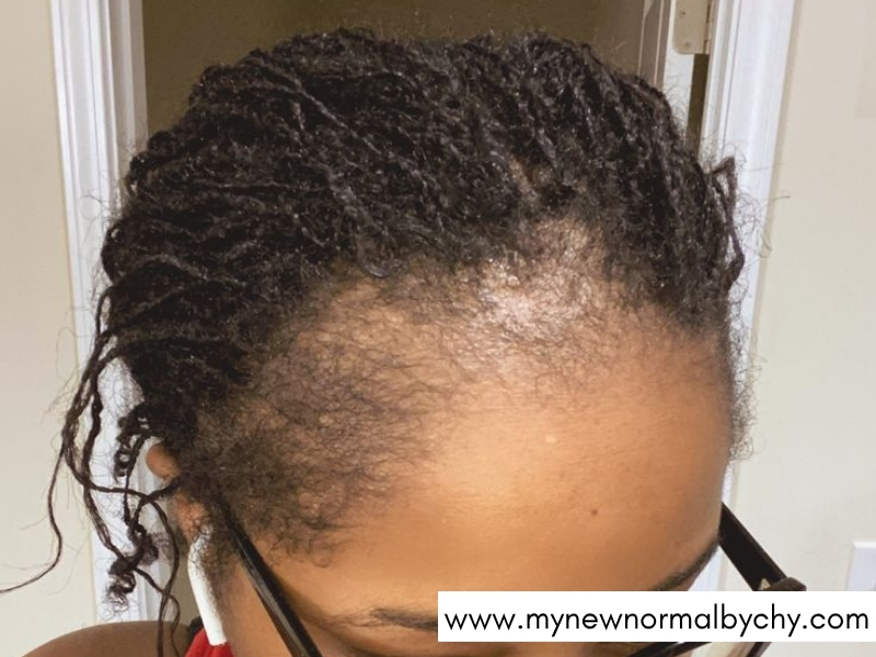 Why-Does-Postpartum-Hair-Shedding-Happen